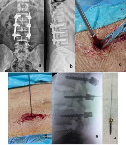 Figure 1 Typical case. Male patient aged 25 years with a history of L3 fracture caused by a car accident 1 year before. (a) Anteroposterior X-ray film before hardware removal. (b) Lateral X-ray film before hardware removal showing bone healing. (c) Incision distraction by the vessel clamp and system-specific set screw retaining compressor insertion. (d) Kirschner wire insertion in a blind manner with the blunt end ahead. (e) Lateral X-ray after Kirschner wire insertion into the axial channel of a percutaneous pedicle screw. (f) Status of the screw with Kirschner wire after removal. A sharp end can be observed on the opposite side of the screw head, indicating that the blunt end was in the screw.