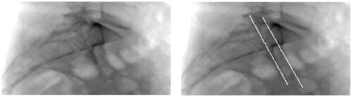 Figure 1. A blank DRR based on unprocessed CT data (l) and a DRR based on CT data on which the anterior iliac surface just lateral to the SIJ has been highlighted on the left and right side (r). The white lines on the right DRR correspond to lines that are used for perioperative lateral alignment.