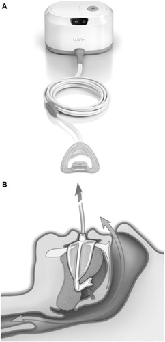Figure 2 (A) Winx device, an oral pressure device that uses gentle suction to anteriorly and superiorly displace the tongue and the soft palate. (B) Effect of oral pressure device on the tongue and soft palate displacement.
