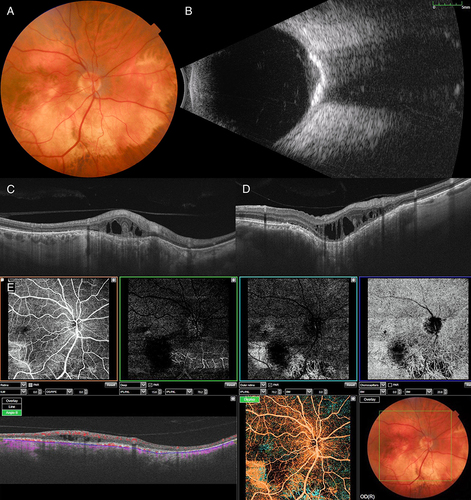 Figure 5 Multimodal imaging in choroidal osteoma. (A) Color fundus photograph shows choroidal osteoma inferior to the optic disc in the right eye. (B) B-mode ultrasonogram shows the dense acoustically solid lesion with posterior shadowing. (C and D) Swept source optical coherence tomography demonstrates choroidal thinning (C and D), focal choroidal excavation (D), retinal pigment epithelial (RPE) atrophy, and intraretinal schisis cavities (C and D). (E) Swept source optical coherence tomography angiography shows visible straight choroidal vessels as well as shadowing due to intraretinal fluid in the choriocapillaris slab. Fine branching vessels within the tumor area may represent intrinsic tumor vasculature. Choroidal vasculature is visible in the outer retinal slab due to unmasking from RPE atrophy.