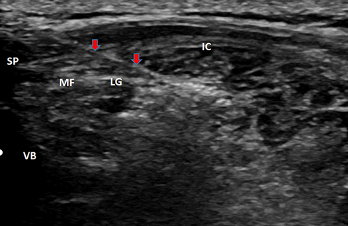 Figure 1 Modified thoracolumbar fascial plane block (MTLIP) anatomical process image in ultrasound. The red arrows show the puncture needle.