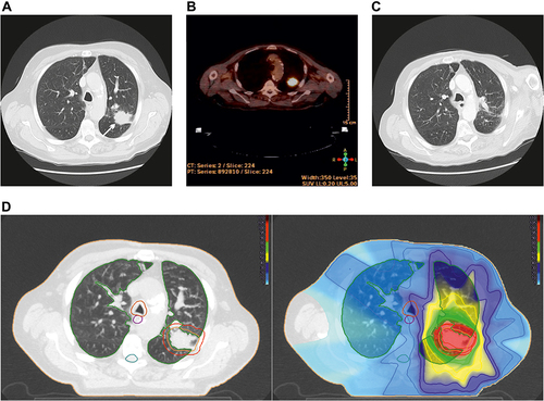 Figure 5 Local control with discreet radiation pneumonitis. (A): 78-year-old patient with histologically confirmed non-small cell lung carcinoma (white arrow). Size about 30 mm. (B): PET/CT for treatment planning. SUVmax = 14.94. (C): Tumour response 3 months after SBRT. Discreet radiation pneumonitis. The patient was asymptomatic. (D left): Tumour within the planning target volume (red contour) and organs at risk: Total lung (green), spinal cord (turquoise), oesophagus (violet) and trachea (orange). (D right): Treatment plan (IMRT-technology, 12 Gy in 5 fractions, total dose 60.0 Gy): Isodose lines (% of total dose) and the dose distribution, high-dose region surrounding the tumour (red, green), step down gradient (yellow, dark blue), and a large low-dose region highlighted in blue.