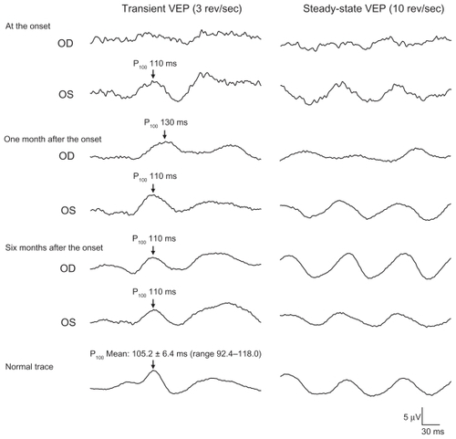 Figure 2 Pattern visual evoked potentials (VEPs). At the onset, pattern VEPs are severely reduced in the right eye. One month after the onset, the P100 component of the pattern VEPs has a prolonged latency of 130 milliseconds. Six months after the onset, the P100 recovers to 110 milliseconds.