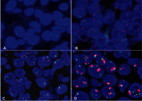 Figure S2 Fluorescent in situ hybridization for MET gene (orange) and centromere 7 (green).Notes: Negative (A); MET polysomy (B); MET amplification (C); tight gene clusters (D). Magnification 1,000×.