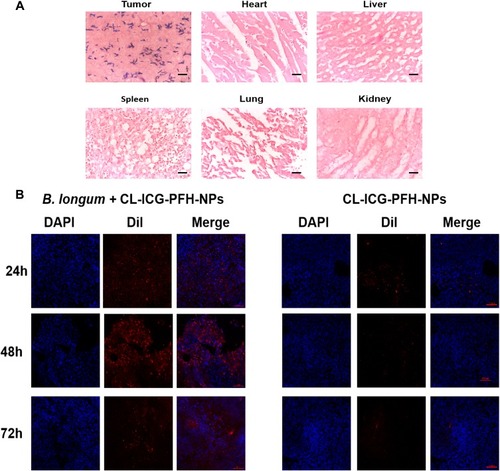 Figure 6 Targeting ability of the biological targeting synergist in vivo. (A) Gram staining for evaluating tumor targeting of B. longum (400 × magnification), the scale bar is 10 µm. (B) CLSM images of tumor tissue at different points (24, 48, 72 h) after injection of DiI-labeled CL-ICG-PFH-NPs (red) in the tail vein, DAPI (blue) marks nuclei, the scale bar is 100 µm.Abbreviations: CLSM, confocal laser scanning microscopy; DiI, 1.1ʹdioctadecy-3,3,3ʹ-tetramethylindocarbocyaninepercholrate; ICG, indocyanine green; PFH, perfluorohexanes.