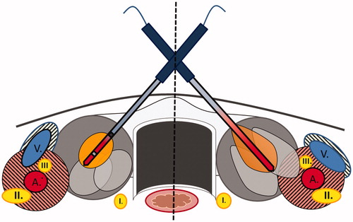 Figure 3. Illustration of different shapes and sizes of thermal ablative zones in thyroid. Left part of the illustration: Cooled RF electrode producing ellipsoid shaped ablation zones. Less heating along the shaft, which results in less damage of passed structures like the skin or M. Sternocleidomastoideus. Heat-sink-effects by large vessels (A and V) protecting contiguous nerve structures such as Vagus nerve (III) or middle cervical sympathetic ganglion (II). Right part of the illustration: uncooled MW antenna inducing ‘tear-drop’ shaped ablation zones as a result of additional heating effects along the shaft. Less heat-sink-effects next to vulnerable structures like middle cervical sympathetic ganglion (II) or Vagus nerve (III) with possible higher risk of unintended harms. I: recurrent laryngeal nerve; II: middle cervical sympathetic ganglion; III: vagus nerve; A: common carotid artery; V: internal jugular vein.