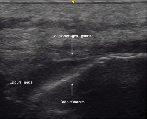 Figure 2 Longitudinal image of the sacrum showing the sacrococcygeal ligament, the base of the sacrum, and the caudal epidural space.