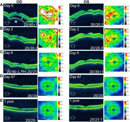 Figure 1 OCT studies of Case 1.