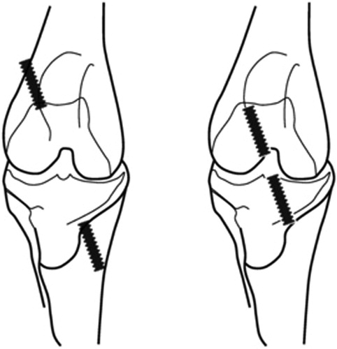Figure 1. (a) Technique 1 “Out-In”: A first interference screw (diameter: 4.5 mm, 20 mm-long) was inserted from outside to inside the articulation from the distolateral femoral metaphysis. After straightening the ligament, a second interference screw was inserted from outside to inside the articulation from the proximo-medial tibia. (b) Technique 2 “In-Out”: This is the same technique as number one, but the interference screw was implanted from inside to outside the articulation from the intra articular space of the stifle towards the metaphysis of the proximal tibia and the distal femur.