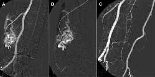 Figure 6 Peripheral arteriovenous malformation treatment.