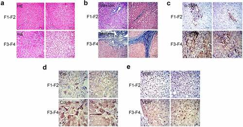 Figure 1. Differential expression and correlation analysis of VDR in patients with liver fibrosis. (a) and (b) Pathology observation of HE and Masson staining of human liver tissue from patients with liver fibrosis (F1-F2: mild liver fibrosis; F3-F4: severe liver fibrosis). (c) and (d) Pathology observation of IHC staining for α-SMA and Col-1 of human liver tissue. (e) The expression of VDR in human liver tissue was detected by IHC staining. Scale bar, 100 μm (×100 magnification).