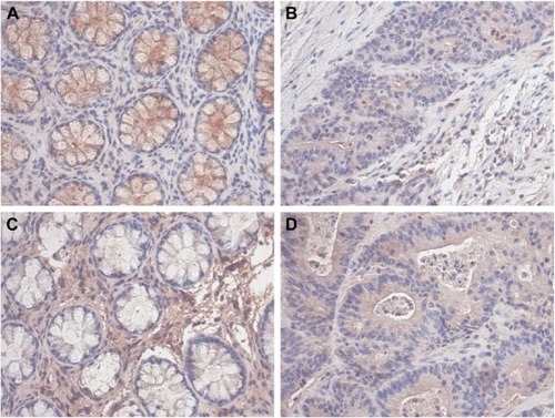 Figure 5 Representative expression of PAX1 and SOX1 protein in colorectal tissues compared with paired normal tissues.