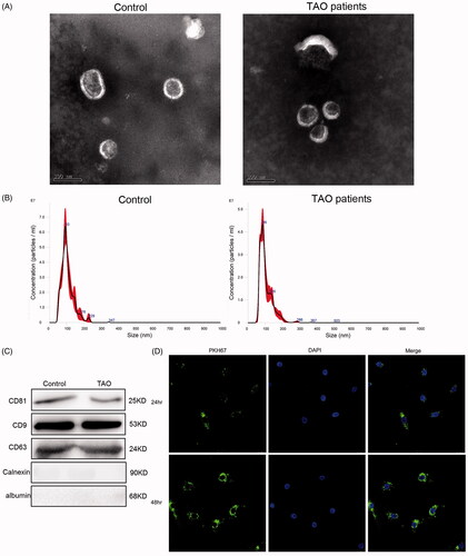 Figure 1. Characterization of plasma-derived exosomes from thromboangiitis obliterans (TAO) patients and control subjects. (A) Representative transmission electron microscopic images of exosomes (scale bar, 100 nm). (B) NTA analysis of the plasma-derived exosomes from TAO patients and control subjects. (C) Expression of CD81, CD9, CD63, calnexin and albumin determined using western blot. (D) PKH67-labelled exosomes could be taken up by human vascular smooth muscle cells (HVSMCs) after co-cultured for 24 h and 48 h (magnification, 400×).