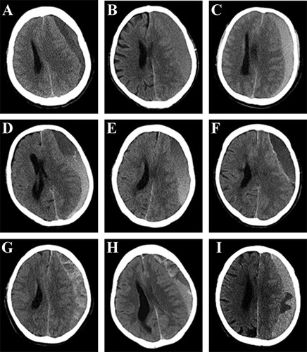 Figure 2 The classification of CSDH according to the hematoma density on CT performance. This classification is based on previous research.Citation10 (A) Homogenous hypodense. (B) Homogenous isodense. (C) Homogenous hyperdense. (D) Separated type, the two components of the hematoma are clearly separated. (E) Gradation type, the density of the hematoma gradually changes from hyperdense to hypodense. (F) Laminar type, a linear hyperdense located in the inner membrane of the hematoma. (G) Trabecular type, the hematoma was separated by several high-density septa. (H and I) Mixed density, two or more types of CT density appear on one layer or on the different layer in one patient.