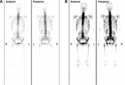 Figure 1 The whole-body bone imaging of case 1.