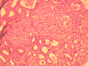 Figure 1. Photomicrograph of renal biopsy shows two glomeruli with deposition of eosinophilic amorphous material in the mesangium and the capillary wall. There is surrounding tubular atrophy and interstitial fibrosis (H&E X250).