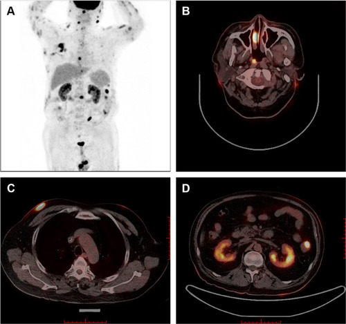 Figure 3 Positron emission tomography/computed tomography shows significant 18F-FDG uptake in multiple sites of the body (A), including the nasopharynx (B), skin and subcutaneous tissue of the right chest (C), small intestine, and kidneys (D).