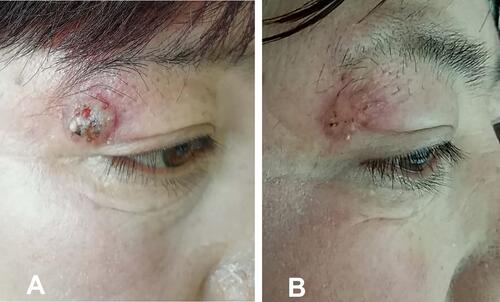 Figure 5 Patient’s condition before and after 1 month of treatment. The patient (A) was prescribed 0.2 g itraconazole twice daily for 3 months. The lesion improved significantly after four weeks of treatment (B).