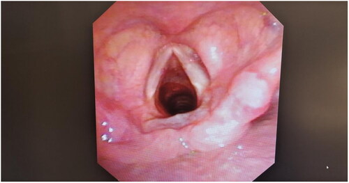 Figure 3. Post-treatment condition of the vocal cord polyp.