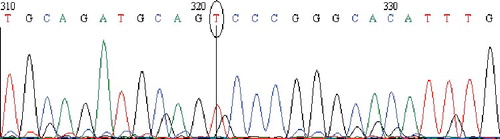 Figure 3. Chromatogram of DNA sequencing for the MT4 (G>A) polymorphism. Minor homozygous individual with an A/A genotype. Note: Reverse primer was used. Visualization with BioEdit (v. 7.2.5) software.