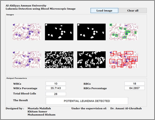 Figure 8. GUI shows an example of classifying the input image into “leukemia.”