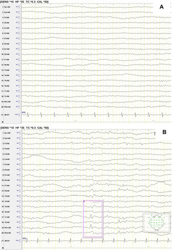 Figure 5 (A) The patient’s EEG after the first seizure in October 2020. (B) The patient’s EEG after the second seizure in October 2020. The pink box showed EEG becomes abnormal situation with sharp and slow waves.