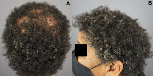 Figure 9 Vertex and left parietal area of patient 3. Images of the vertex and posterior scalp (A) and left parietal area (B) of a patient with central centrifugal cicatricial alopecia obtained at 3 months and 4 months, respectively, after cessation of oral minoxidil and using topical Gashee twice a day as sole therapy.