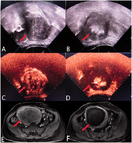 Figure 1. A 45-year-old patient with an 8.7 × 8.5 × 8.3 cm uterine fibroid and the significant grey-scale change during HIFU treatment. (A) Before HIFU treatment, ultrasound showed a hypoechoic fibroid (arrow). (B) Immediately after HIFU treatment, ultrasound showed a lumpy grey-scale change in the treatment area (arrow). (C) Before HIFU treatment, contrast-enhanced ultrasound showed the tumour perfusion area (arrow). (D) Immediately after HIFU treatment, contrast-enhanced ultrasound showed no enhancement surrounding the fibroid (arrow), indicating complete ablation. (E) Pre-treatment enhanced T1-weighted MRI showed tumour perfusion (arrow). (F) Post-treatment enhanced T1-weighted MRI showed a small area of enhancement along the tumour edges, with an ablation rate of 94% (arrow).