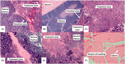 Figure 3. Microscopic images (hematoxylin and eosin) at 100× magnification. Thin transition zones (A & B) were seen between treated and normal tissue. Areas of complete and partial necrosis were seen within the treatment zone (C, D, E). Swollen muscle cells with interstitial edematous changes (E) were seen overlying two treatment zones, however their nuclei remained intact.