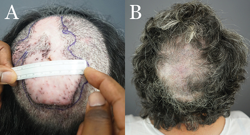 Figure 4 Patient 1: Preoperative FD plaque involving the vertex, mid-scalp extending to the frontal scalp. (A) Thirteen months after complete excision of FD lesion and healing by second intention, aided by high-tension sutures with guards and a minor skin graft (B).