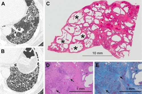 Figure 5 UIP pattern on thin-section CT images and histological findings.Notes: (A and B) Thin-section CT images showing clustered cysts of similar size and shape. Note surrounding ground-glass attenuation with reticular opacity. (C) This low-power photograph of the histological section (hematoxylin–eosin stain) reveals macroscopic honeycombing (asterisk) corresponding to honeycombing on thin-section CT images and patchy fibrosis with architectural distortion and microscopic honeycombing reflecting ground-glass attenuation with reticular opacity. (D) Note dense fibrosis and fibroblastic foci (arrow) on high-power photographs of the histological section. (E) Masson’s trichrome stain reveals architecture destruction with scattered fibroblastic foci (arrow).Abbreviations: UIP, usual interstitial pneumonia; CT, computed tomography.