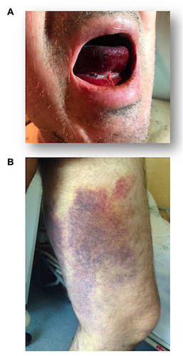 Figure 3 Examples of AHA bleeding profile. (A) Lingual and soft palate haematoma in patient with AHA. (B) Haemorrhagic infiltration of subcutaneous tissue due to abductor muscle bleeding in a patient with AHA.