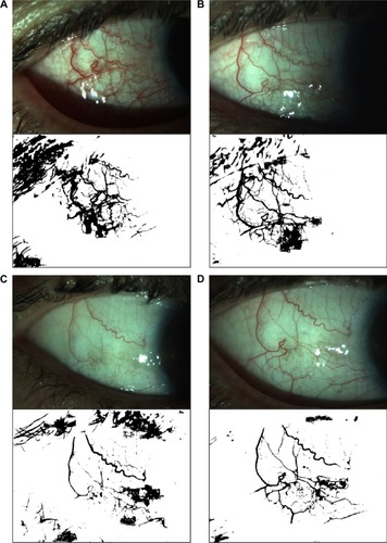 Figure 1 Bulbar conjunctival vascularization area.