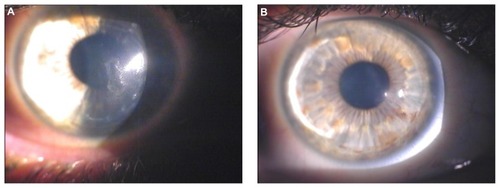 Figure 2 Biomicroscopic image of the right eye of a 29-year-old male patient. (A) Three years after excimer laser-assisted lamellar keratoplasty, a mild central scar secondary to delayed epithelial healing is visible. (B) Two years after customized photorefractive keratectomy and corneal collagen cross-linking with riboflavin and ultraviolet A irradiation, the central scar is considerably reduced and the overall corneal clarity appears improved.