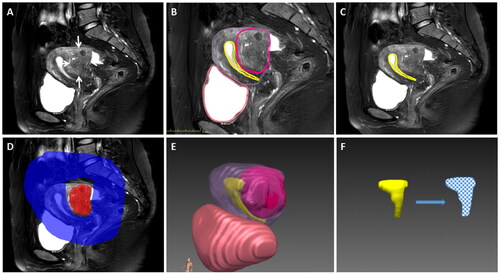 Figure 2. Diagrams of the of 3D reconstruction of MRI. With the adenomyotic lesion (arrows) identified clearly on T2WI (A), the segmentation could be accomplished by marking the target in red and the surrounding structures in blue (D) on 3 ∼ 5 different planes. By activating the reconstruction function, the system could identify the outline of the target automatically (B,C) by analyze the signal intensity and distribution of the marked area. After all the targets were reconstructed, a vivid 3D map reflecting the spacial relationship between the adenomyotic lesion (pink) and endometrium (yellow), uterine corpus (purple), and bladder (red) could be generated (E). The system will automatically identify the numbers of pixels inside and the reconstructed structure, and calculate the volume and surface area measurement values (F).