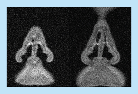 Figure 3. Nasal valve secretion and collapse in MRIs used to develop the Optinose cast.Cross-sections in the nasal valve region from MRI used to develop Optinose cast. The images show secretion partly obstructing the upper slender part of the valve and partial collapse of the upper part of the valve region on the left side.