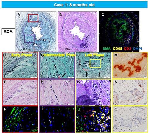 Figure 3 Representative histologic sections of the right coronary artery, from the same case shown in Figure 2. Top row: low-power images of RCA stained with Movat Pentachrome (A), hematoxylin and eosin (B), and triple immunofluorescence for SMC and inflammatory markers [macrophage (CD68) and T cells (CD3)], and α-actin (SMA) (C). Early- (D–F), intermediate- (G–I), and late-phase (J–O) lesion morphologies are shown. There is moderate luminal narrowing with SMC-rich neointima. Regions of interest shown at higher magnification are within the colored boxed areas on the low-magnification image (A). Areas highlighted by the red box (D–F) show early calcification with degradation of the IEL and relative absence of inflammation. The purple-boxed area (G–I) represents fragmentation and focal thickening of elastic fibers with calcification, along with early inflammation (macrophages, yellow in panel (I) and neoangiogenesis (black arrow). A more advanced late phase (black in panel (A) and yellow boxes in panel (J) shows more prominent calcification (M, alizarin red) and neoangiogenesis (black arrows in panel (J) with inflammatory infiltrate (C and L) consisting mostly of macrophages and T cells together with a loss of adjacent SMCs. These areas were also typically positive for the calcification markers, osteoprotegerin(N) and receptor activator of the nuclear κB (RANK) (O). (A–O) are reproduced with permission from Federici et al.Citation58