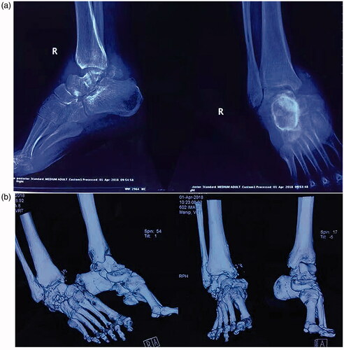 Figure 2. Radiological views in right ankle at anteroposterior (left), lateral (right) position (a) and 3D reconstruction of CT scanning in CN ankle (b).