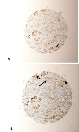 Figure 5. Two representative sections taken from the same tumour, a grade 2 OSCC from the Bucca cavioris, on the microarray. (A) beta-Catenin staining; (B) SALL4 staining. More cells have stained with SALL4 than with beta-Catenin (thick arrow, (B)). However, cells staining with beta-Catenin were also stained with SALL4 (thin arrows, (A) and (B)). Both markers has predominant nuclear and cytoplasmic staining of tumour cells (arrow heads, (A) and (B)). (Magnification X10).