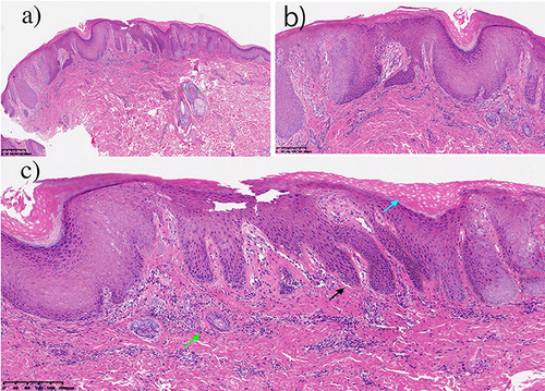 Figure 2 Microscopic Examination of Tissue Sections: Histopathological Findings. (a and b) Acanthosis of the epithelium with elonged rete ridges, as well as the lymphocytic infiltration around dermal blood vessels and appendages; (c) Blue arrow; epidermal dyskeratosis and hyperkeratosis, Black arrow; acanthosis with elonged rete ridge, Green arrow; lymphocytic infiltration around dermal blood vessels and appendages.