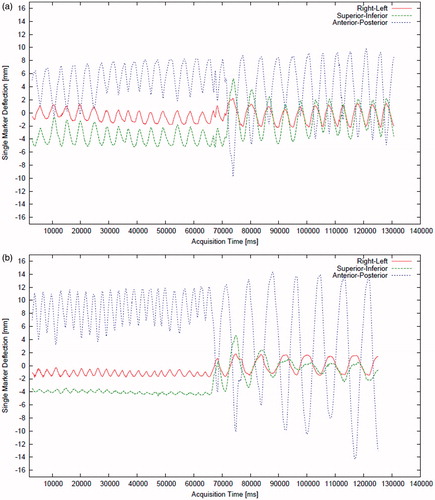 Figure 3. The time diagram for the skin central marker positions (near the navel) acquired with the Claron H×40 stereo camera for healthy male (a) and female (b) patients. The first minute shows shallow breathing; the second minute shows deep breathing. The position of the markers is spread in the right-left (RL), superior-inferior (SI) and anterior-posterior (AP) spatial directions.