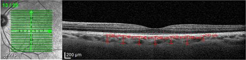 Figure 1 Choroidal thickness measurements were made in the subfoveal choroid and at 500-µm intervals from the fovea to 1500 µm temporal, 1500 µm nasal, 1500 µm superior and 1500 µm inferior (13 locations).