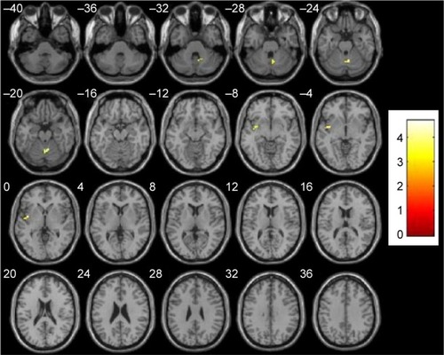 Figure 4 Altered resting-state FC in the SN in schizophrenia patients before and after treatment: decreased FC in the right cerebellum anterior lobe and left insula.