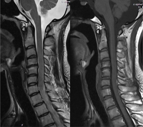 Figure 2 Reverse sigmoid type cervical kyphosis with Modic-2 changes in C4–C5.