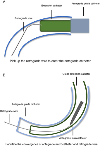 Figure 1 Depiction of guide extension catheter-facilitated tip-in technique. (A) The guide extension catheter could advance into the coronary artery to “pick up” the retrograde wire. (B) The guide extension catheter narrowed the lumen which facilitated the entry of retrograde wire into the antegrade microcatheter.