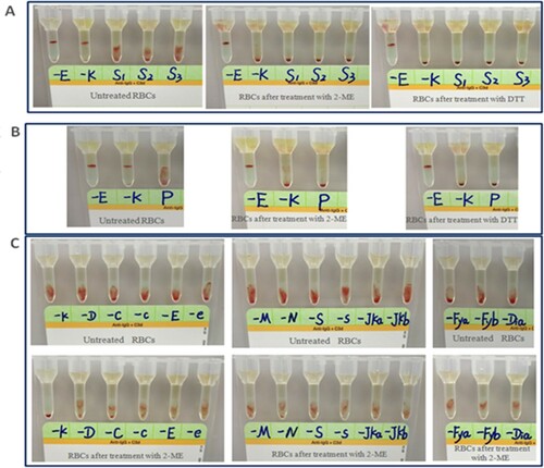 Figure 1. Representative results of pre-transfusion compatibility test using IATs in a Chinese patient undergoing DARA treatment. (A) Antibody screening results of patients before and after 2-ME/DTT treatment. (B) Cross-matching results of patients before and after 2-ME/DTT treatment. (C) Antigen detection results before and after 2-ME treatment in panel RBCs. -E, anti-E antibody; -K, anti-K antibody; S1 to S3, antibody screening cells 1–3; P, major cross-matching of this patient; -D, anti-D antibody; -C, anti-C antibody; -c, anti-c antibody; -e, anti-e antibody; -M, anti-M antibody; -N, anti-N antibody; -S, anti-S antibody; -s, anti-s antibody; -Jka, anti-Jka antibody; -Jkb, anti-Jkb antibody; -Fya, anti-Fya antibody; -Fyb, anti-Fyb antibody; -Dia, anti-Dia antibody.