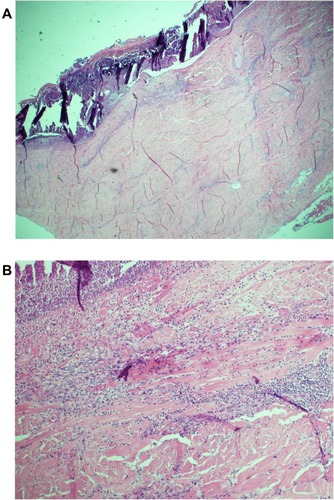 Figure 2 Histology of incisional biopsy of abdominal ulcer. (A) Extensive skin ulceration is shown (H&E stain; original magnification ×10). (B) Higher-powered view of ulcer being covered by inflamed crust and infiltrated by a heavy collection of acute inflammatory cells (neutrophils) (H&E stain; ×20).