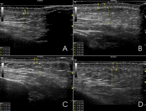 Figure 3 Ultrasound qualification of dermal changes of the right hemiface: (A) Before the procedure, (B) After 1 week, (C) after 2 weeks, (D) after 3 weeks.
