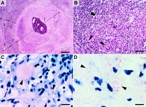 Figure 2 Histological characteristics of a tuberculous granuloma in the late caseo-calcareous stage. Image (A) “caseating tubercule” consisting of a large central area of caseating necrosis (zone 1) with extensive calcification (asterisk), surrounded by a reactive rim (zone 2) of lymphocytes and macrophages (including macrophage-derived epithelioid and multinucleated giant cells) and bordered by a partially formed fibrous capsule (zone 3) focally infiltrated by the above-mentioned cells; Image (B) detail of the leukocyte rim (zone 2), depicting several multinucleated giant cells (Langhans type) (arrowheads) admixed with fewer histiocytes, macrophages, and lymphocytes (arrow). Image (C and D) many acid-fast bacilli located intracellularly within the Langhans type multinucleate giant cells and histiocytes (image (C), arrowheads) and extracellularly (image (D), arrowheads). Image (A and B), Hematoxylin and eosin stain; Image (C and D) Ziehl–Neelsen stain for mycobacteria; ob x 4 for image (A) (scale bar=500 µm), x20 for image (B) (scale bar=100 µm), and x100 for images (C and D) (scale bar=20 µm).