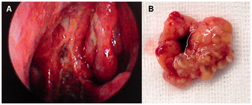 Figure 3. (A) Endoscopic appearance in a 5-year follow-up revision. No evidence of recurrence in the residual septal area or nearby zones. (B). Macroscopic aspect of the tumor.